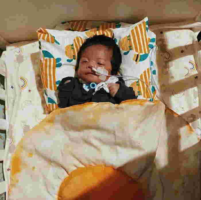 Experiencing Moebius Syndrome, This is the Story of a Baby Born Without Facial Expressions