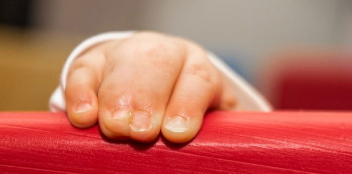 Mengenal Kelainan Sindaktili, Kondisi Jari Dempet yang Bisa Dialami Bayi