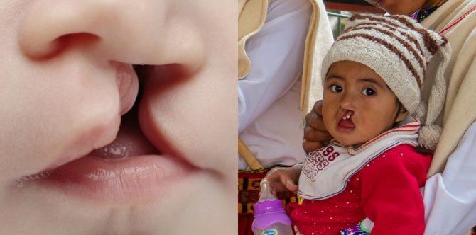 Penyebab dan Cara Menyembuhkan Bibir Sumbing pada Anak