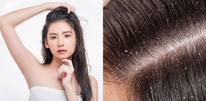 14 Cara Menghilangkan Ketombe Secara Alami dan Permanen, Cek!