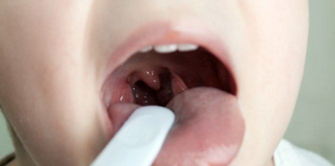 Penyakit Amandel pada Anak, Haruskah Dioperasi? Ini Jawabannya, Parents