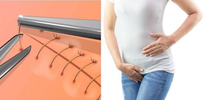 10 Tips Merawat Jahitan Setelah Melahirkan Normal agar Lekas Sembuh dan Tidak Infeksi