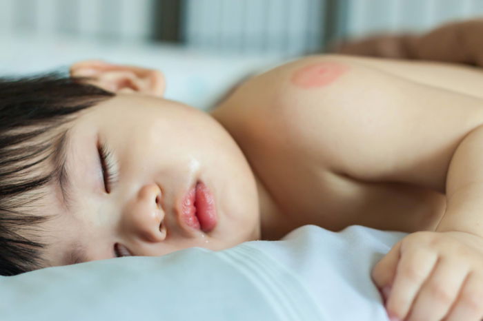 5 Cara Mengatasi Alergi Anak yang Diturunkan dari Orangtua, Kenali Gejalanya