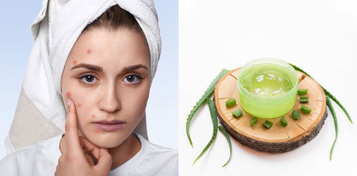 19 Cara Bantu Hilangkan Jerawat, Perlu Dicoba Agar Kulit Wajah Sehat