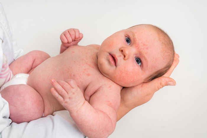 5 Masalah Kulit Bayi Ini Paling Sering Terjadi, Intip Cara Perawatannya