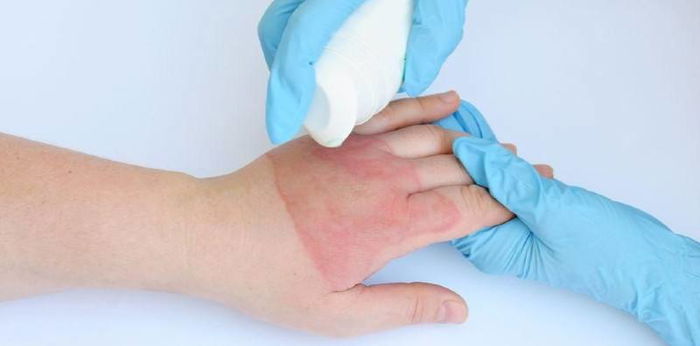 5 Rekomendasi Obat Luka Bakar, dari yang Alami Hingga Beli di Apotek