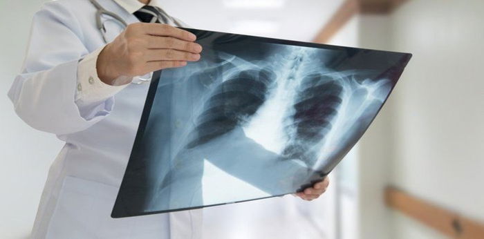 Hari TB Sedunia, Ini 11 Fakta Seputar Penyakit Tuberkulosis di Indonesia