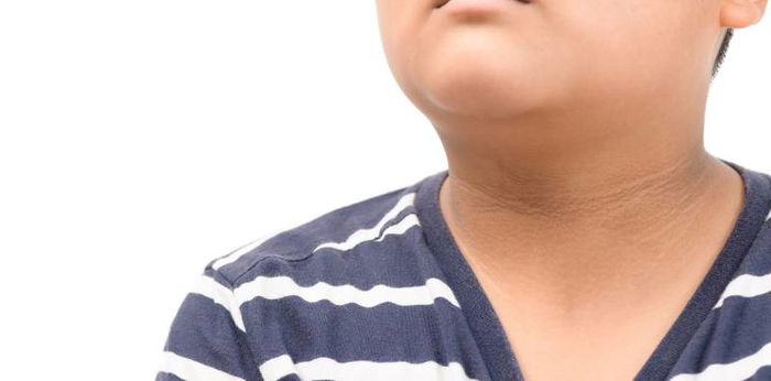 Acanthosis Nigricans: Gejala, Penyebab, Diagnosis, Pengobatan