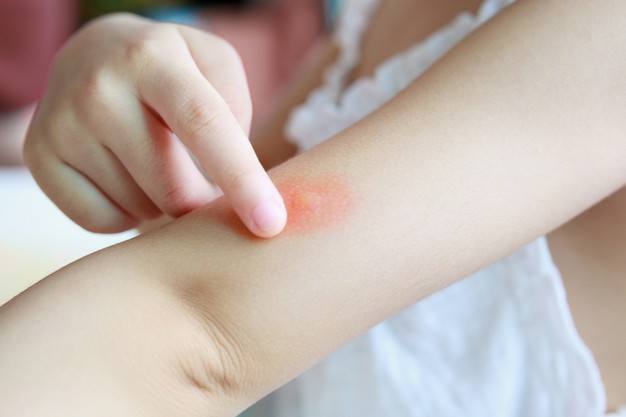 4 Hal yang Harus Bunda Lakukan Jika Si Kecil Alergi Susu Sapi