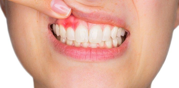 Periodontitis, Penyakit Gusi yang Tidak Bisa Disepelekan