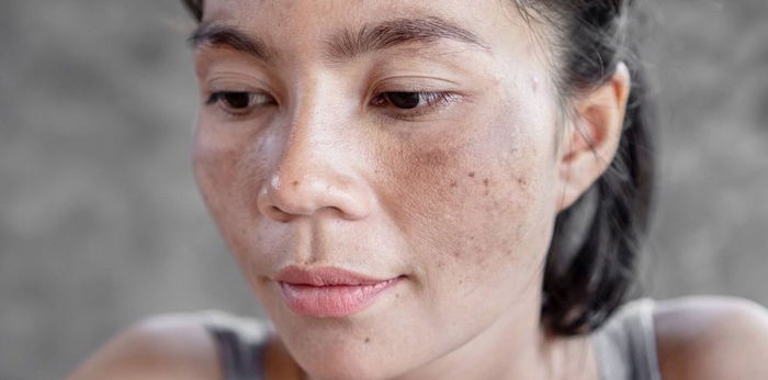 Cara Menghilangkan Belang di Wajah, Lebih Baik dengan Cara Alami atau Medis?