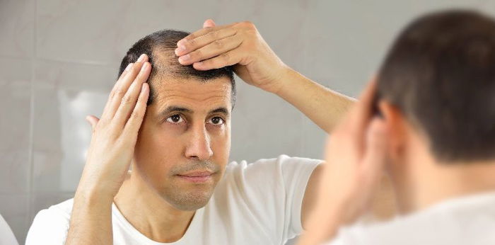 Rambut Semakin Menipis? Cek 5 Tanda Kebotakan Ini dan Cara Mengatasinya