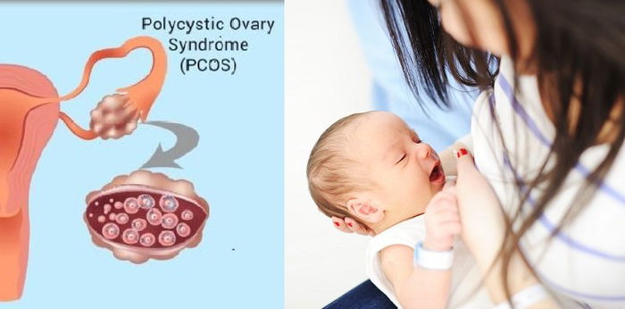 Mengapa Ibu dengan PCOS Sulit Menyusui? Bagaimana Cara Mengatasinya?