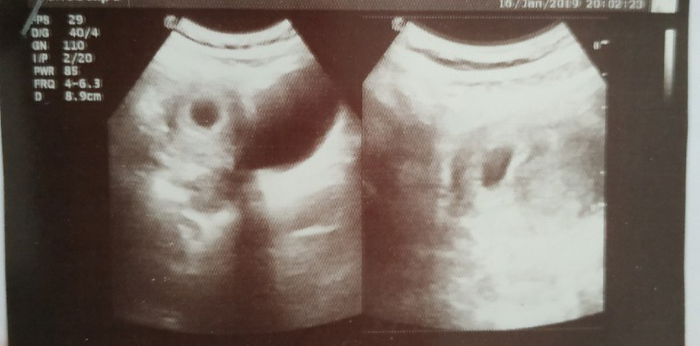 My Pregnancy Journey: A Bitter yet Sweet Experience 