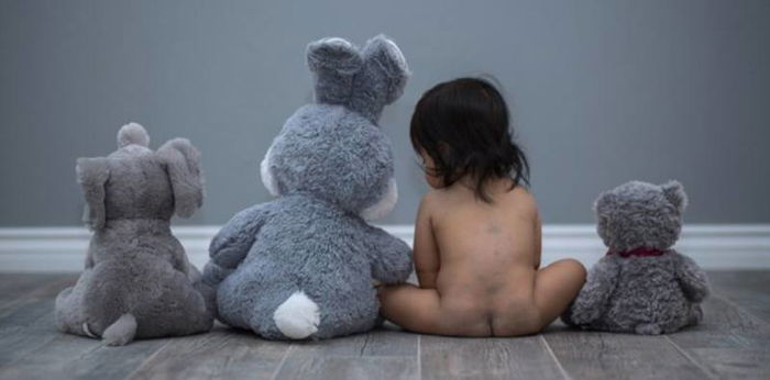 Kenali 6 Jenis Tanda Lahir Bayi dan Cirinya yang Berbahaya