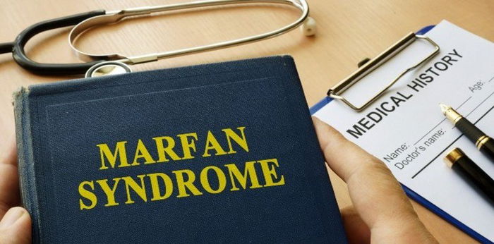 Sindrom Marfan: Gejala, Penyebab dan Cara Mengobati