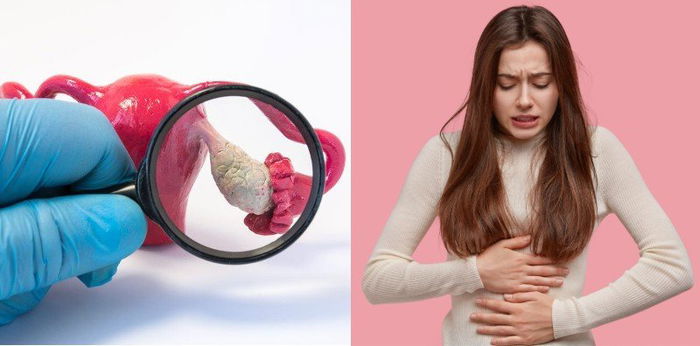 Sulit Dideteksi, Ini Upaya Pencegahan Penyakit Kanker Ovarium