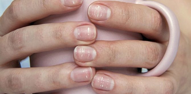 Covid Nails Tanda Infeksi Virus Corona pada Kuku, Ini Cirinya