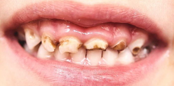 6 Penyebab Gigi Anak Hitam Beserta Cara Mengatasi dan Mencegahnya