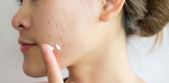 Benzolac Obat Oles Jerawat, Pahami Manfaat dan Cara Penggunaannya