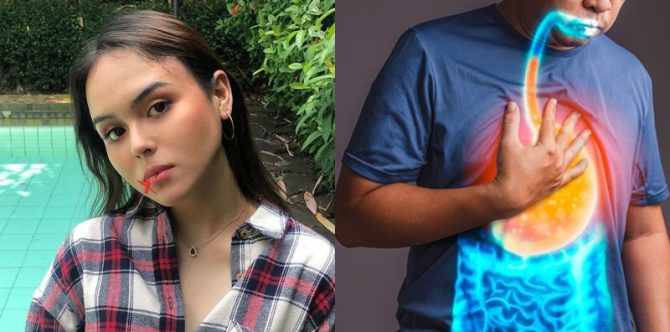 Isu Laura Anna Meninggal karena GERD, Benarkah Asam Lambung Sebabkan Kematian?