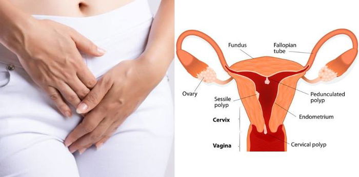 Jangan Sampai Salah! Ini Perbedaan Polip Serviks dan Polip Rahim