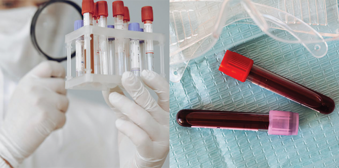 Peneliti Kembangkan Tes Darah untuk Deteksi Dini Kanker, Tingkat Akurasi Tinggi!