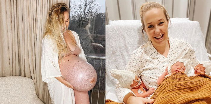 12 Potret Baby Bump Ibu Hamil Triplet Asal Denmark, Ukurannya Besar Banget!