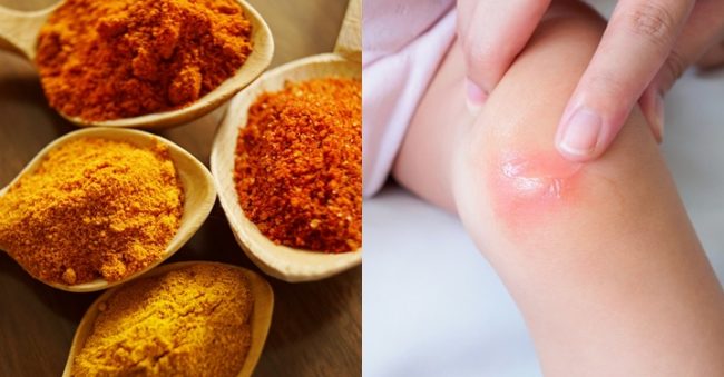 6 Cara Mengobati Bisul Dengan Memakai Bahan Alami 6 Cara Mengobati Bisul Dengan Memakai Bahan Alami