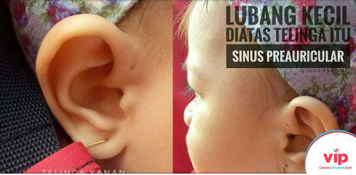 Lubang Kecil di atas Telinga Dimiliki Anakku, Apakah Berbahaya?