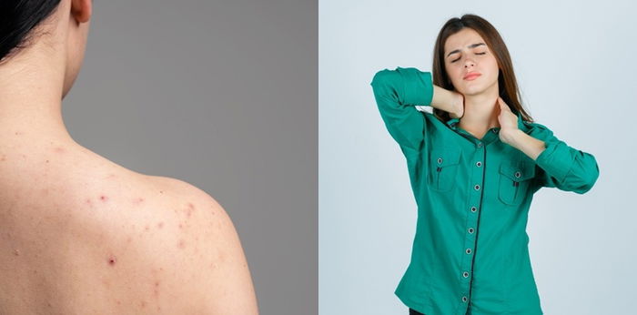 Biang Keringat: Jenis, Gejala, Penyebab, hingga Cara Mengobatinya