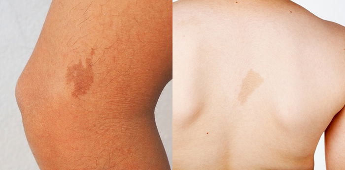 Mengenal Cafe Au Lait Spot, Tanda Lahir Bayi yang Mirip Noda Kopi