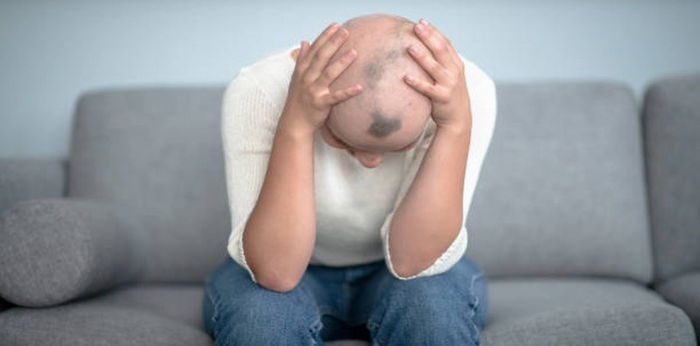 Alopecia Areata: Saat Rambut Rontok Berlebihan, Bisakah Disembuhkan?