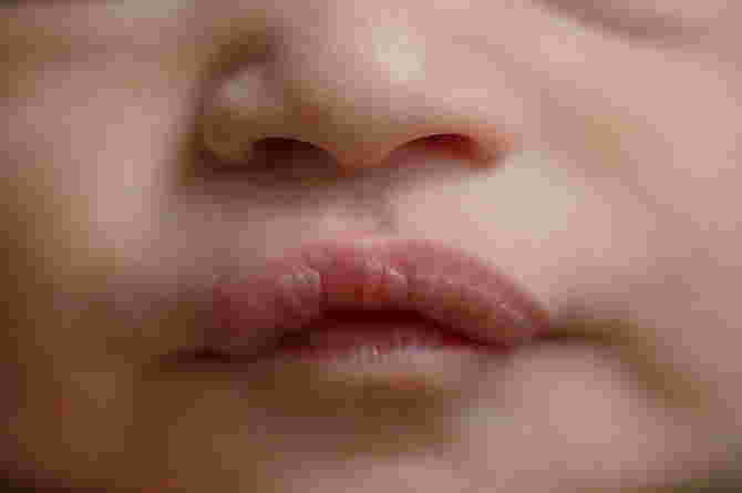 Getting to Know Suck Blisters, a Condition of Blisters on the Lips of Breastfed Babies