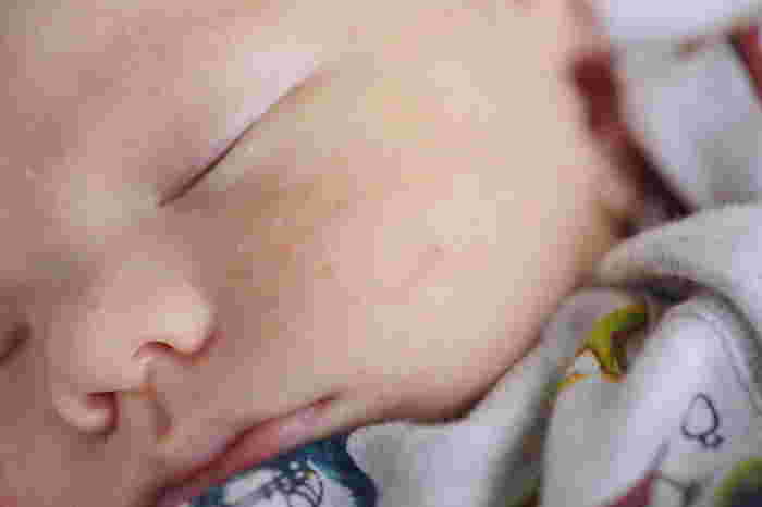 Get to Know Erythema Toxicum Neonatorum: Causes, Symptoms, and Treatment