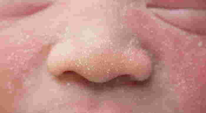 erythema toxicum neonatorum