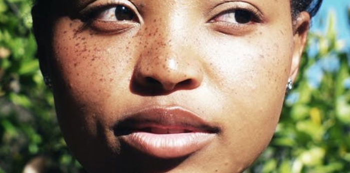 Biar Gak Salah Treatment, Kenali Perbedaan Flek Hitam, Freckles, dan Melasma!