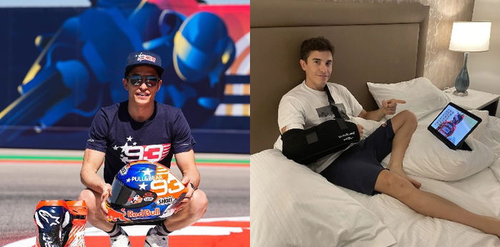Kondisi Teranyar Marc Marquez Usai Jalani Operasi Keempat Kalinya