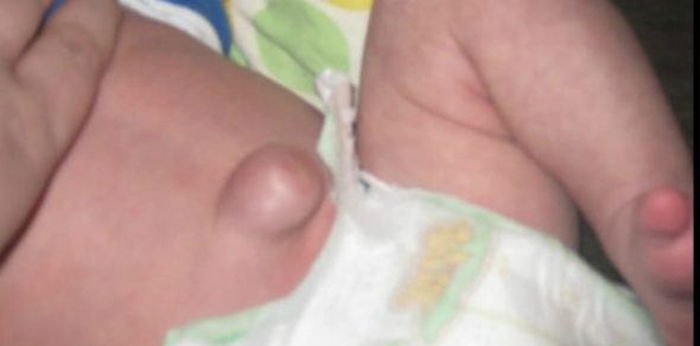 Hernia Umbilikalis atau Pusar Bodong Pada Bayi, Apakah Berbahaya?