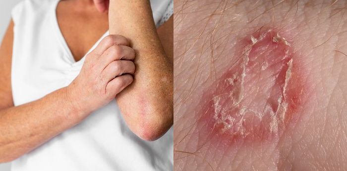 Infeksi Jamur Ringworm Pada Kulit, Kenali Jenis, Gejala, dan Pengobatannya 