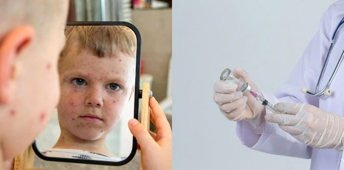 Ini Ciri dan Gambar Bintik Campak pada Anak, Ketahui Cara Mencegahnya!