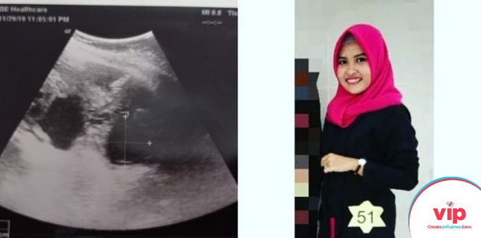 Hamil dengan Kista, Inilah Pengalaman Berharga yang Kurasakan