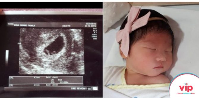 Alami PCOS, Saya Berhasil Hamil Setelah Satu Tahun Menikah