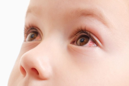 4 Jenis Sakit Mata pada Anak, Gejala, Penyebab, Mengatasinya