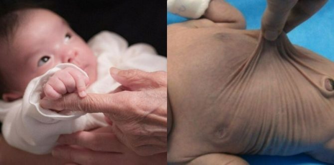 Sindrom Cutis Laxa saat Bayi Keriput Seperti Lansia: Ini Gejala, Penyebab, dan Cara Mengobati