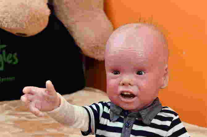 Harlequin Ichthyosis in Babies: Symptoms, Causes, Treatment