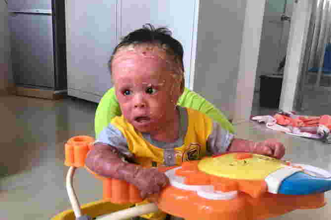 Harlequin Ichthyosis pada balita ditandai dengan kulit yang merah