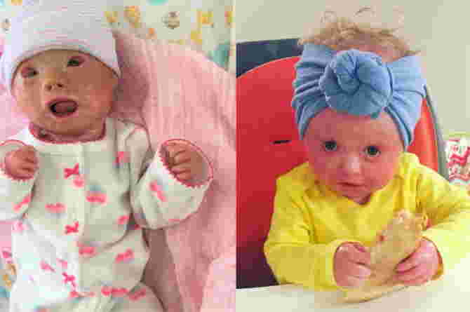 Harlequin Ichthyosis in Babies: Symptoms, Causes, Treatment