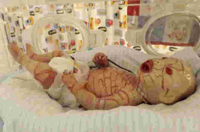 bayi lahir dengan Harlequin Ichthyosis