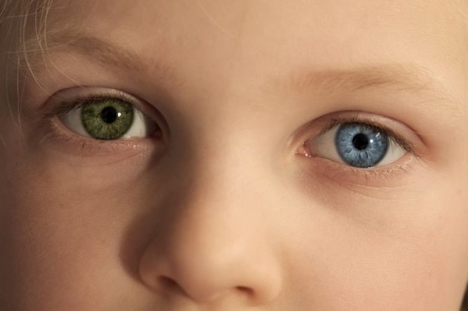 Getting to Know Waardenburg Syndrome, a Rare and Miraculous Genetic Disorder